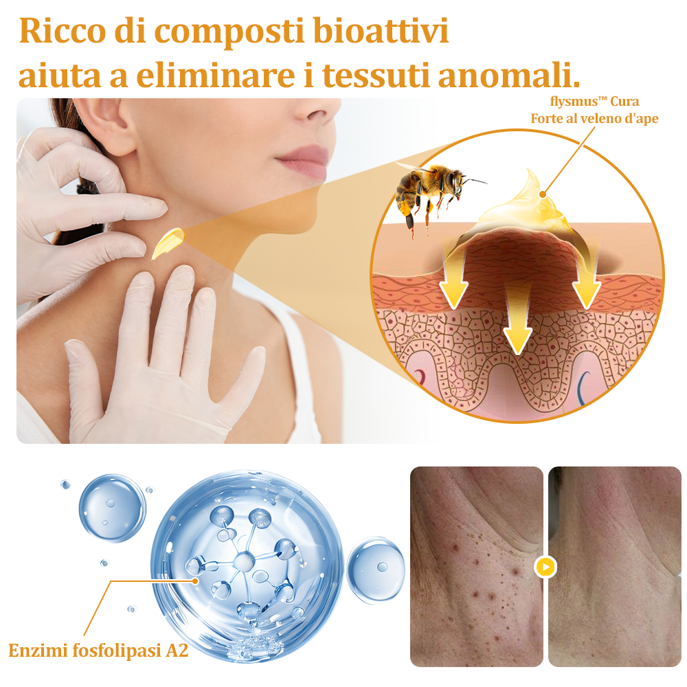 👨⚕️flysmus™ Cura Forte al veleno d'ape, Tratta verruche, escrescenze, infezioni e cicatrici, Leviga la pelle irregolare, Certificato dalla Società Italiana di Dermatologia (SIDeMaST) 🌟