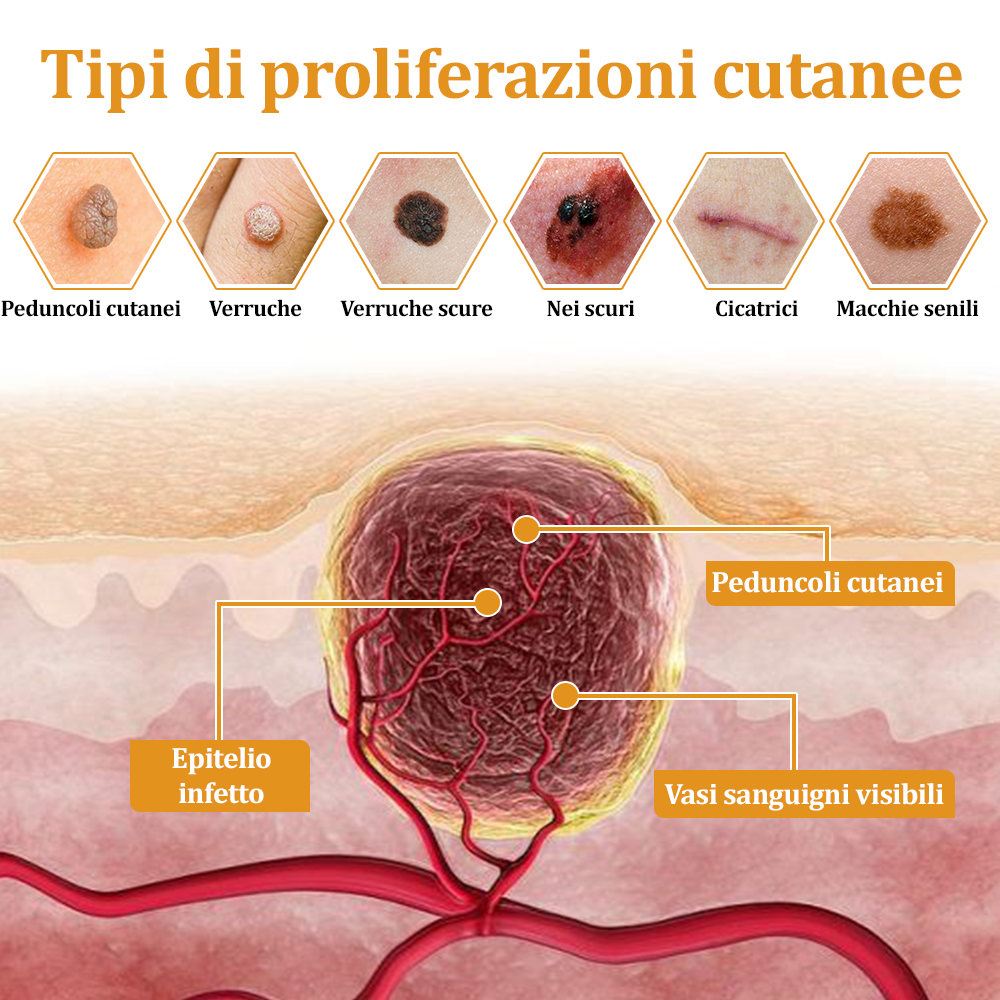 👨⚕️flysmus™ Cura Forte al veleno d'ape, Tratta verruche, escrescenze, infezioni e cicatrici, Leviga la pelle irregolare, Certificato dalla Società Italiana di Dermatologia (SIDeMaST) 🌟