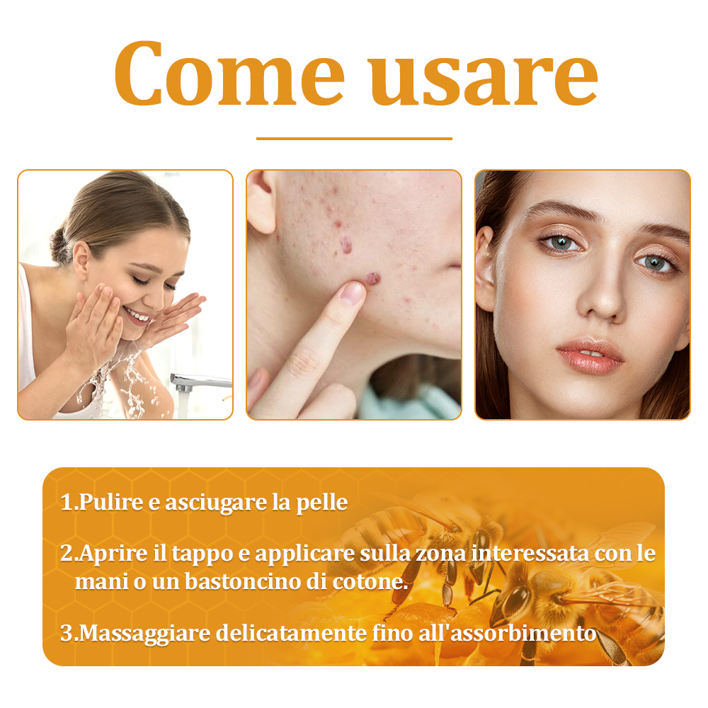 👨⚕️flysmus™ Cura Forte al veleno d'ape, Tratta verruche, escrescenze, infezioni e cicatrici, Leviga la pelle irregolare, Certificato dalla Società Italiana di Dermatologia (SIDeMaST) 🌟