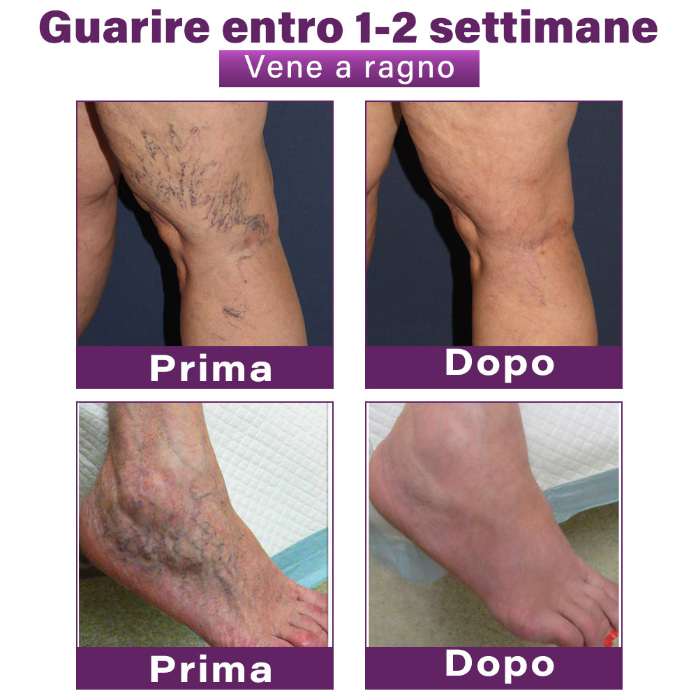 ✅ GFOUK® Cerotto Nano Varicose con Polidocanolo 👩🏼⚕️ Raccomandato dalla Società Italiana di Chirurgia Vascolare (Per Varici, Vene Varicose e Gonfiore alle Gambe)