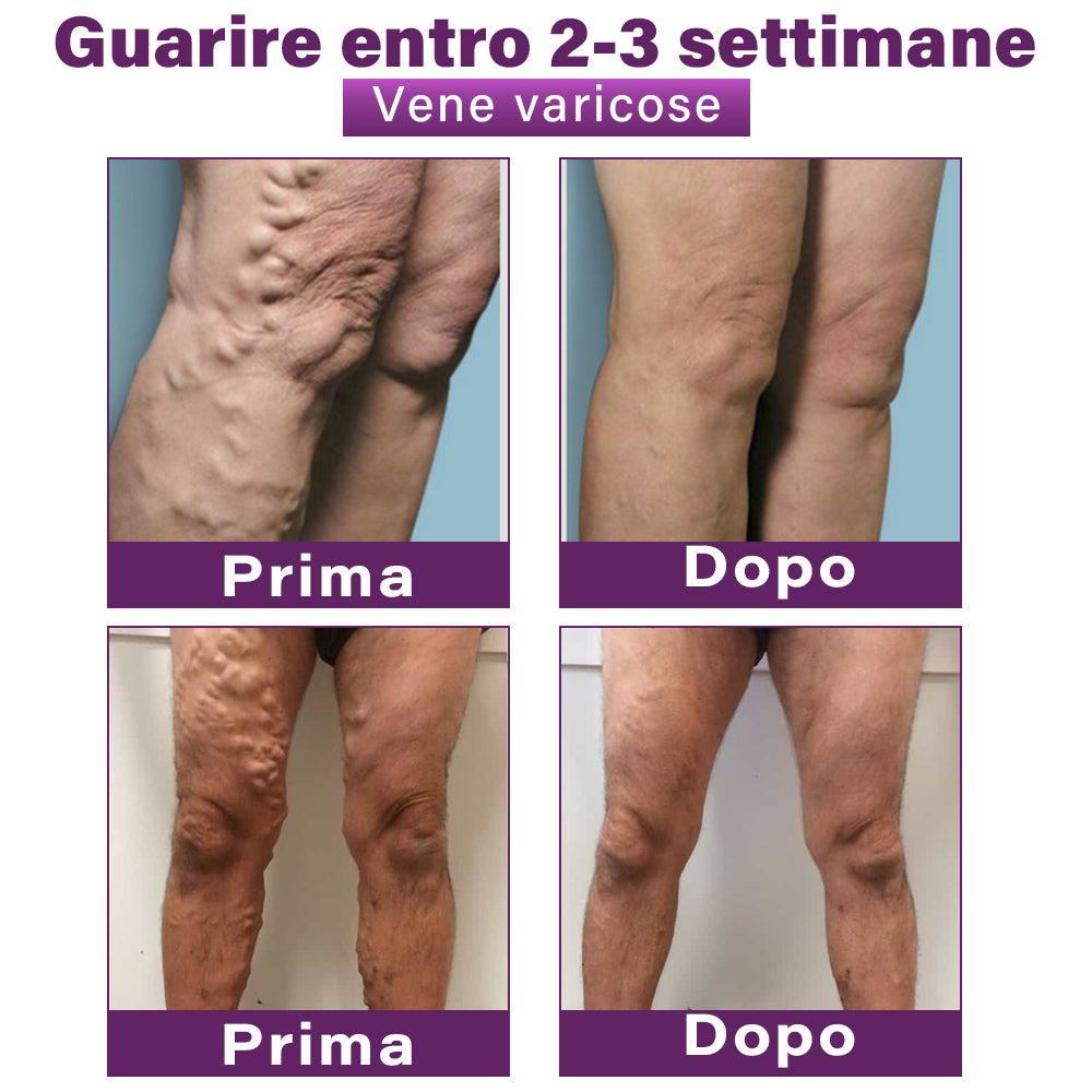 ✅ GFOUK® Cerotto Nano Varicose con Polidocanolo 👩🏼⚕️ Raccomandato dalla Società Italiana di Chirurgia Vascolare (Per Varici, Vene Varicose e Gonfiore alle Gambe)