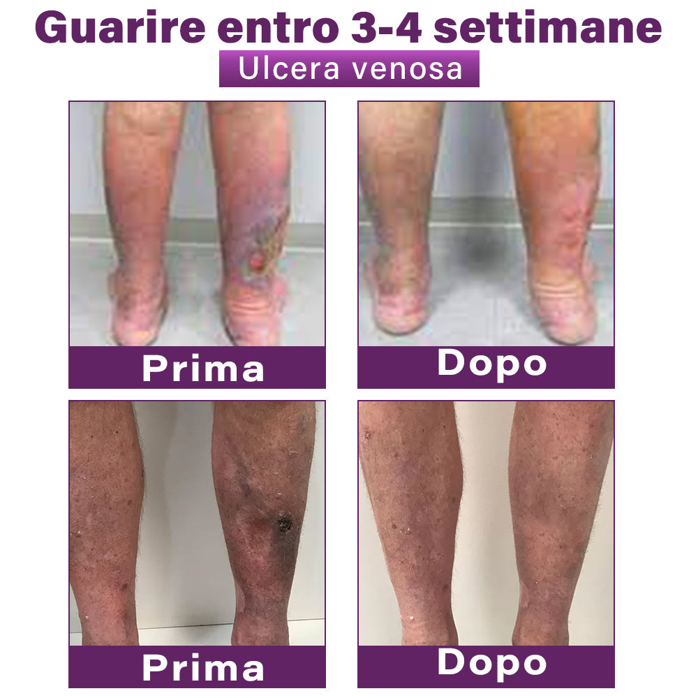 ✅ GFOUK® Cerotto Nano Varicose con Polidocanolo 👩🏼⚕️ Raccomandato dalla Società Italiana di Chirurgia Vascolare (Per Varici, Vene Varicose e Gonfiore alle Gambe)