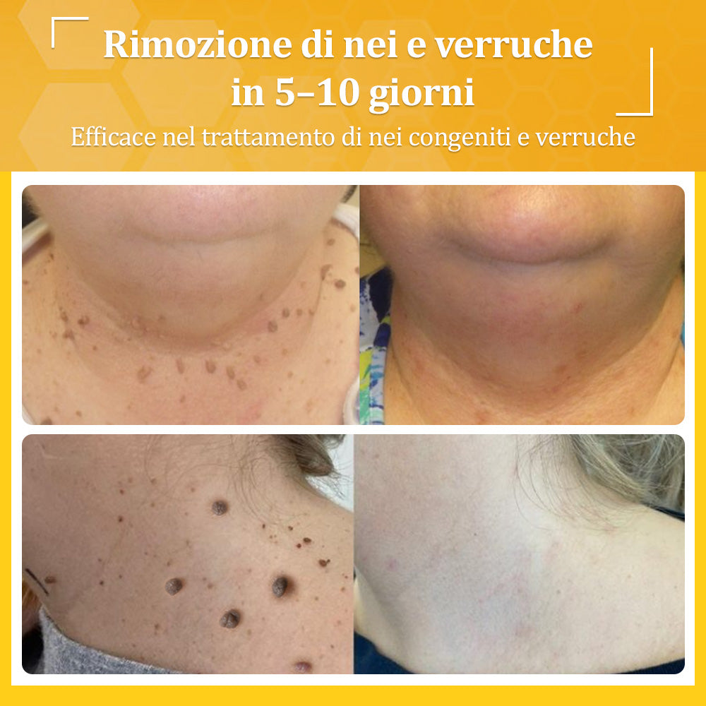 👩⚕️flysmus® Crema al Veleno d’Ape – Testata da dermatologi. Efficace contro verruche, noduli, lesioni, infezioni e cicatrici.