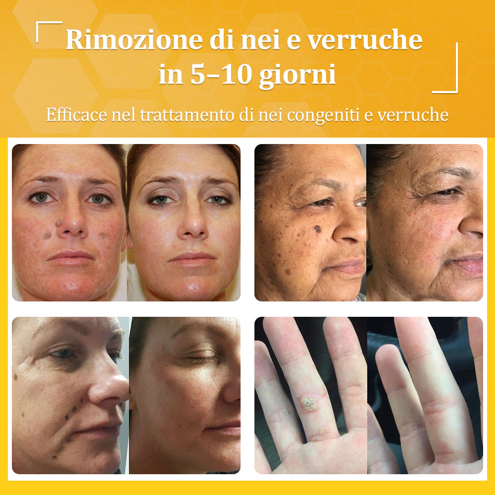 👩⚕️flysmus® Crema al Veleno d’Ape – Testata da dermatologi. Efficace contro verruche, noduli, lesioni, infezioni e cicatrici.