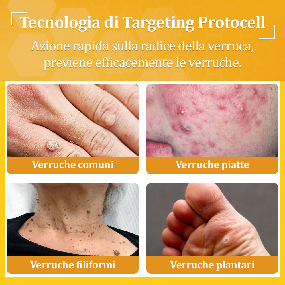 👨⚕️flysmus™ Cura Forte al veleno d'ape, Tratta verruche, escrescenze, infezioni e cicatrici, Leviga la pelle irregolare, Certificato dalla Società Italiana di Dermatologia (SIDeMaST) 🌟