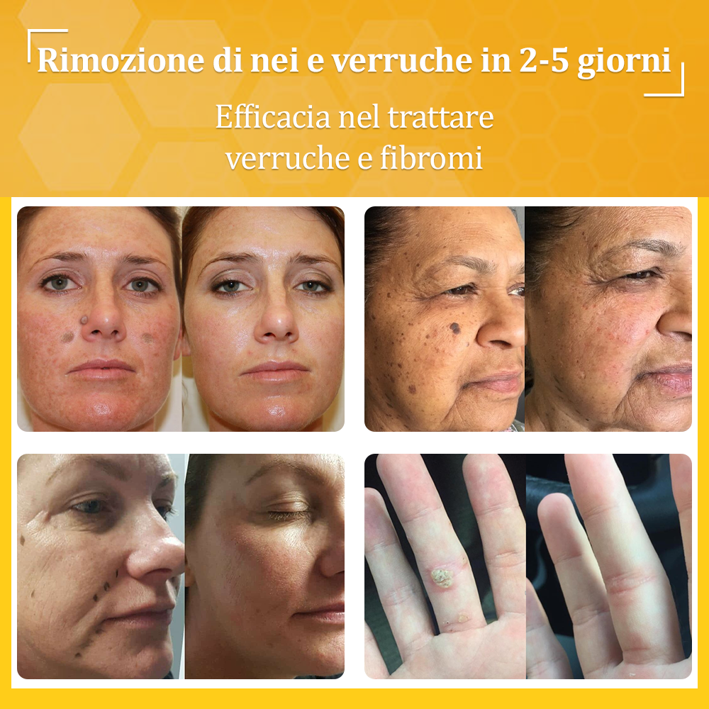 👨⚕️flysmus™ Cura Forte al veleno d'ape, Tratta verruche, escrescenze, infezioni e cicatrici, Leviga la pelle irregolare, Certificato dalla Società Italiana di Dermatologia (SIDeMaST) 🌟