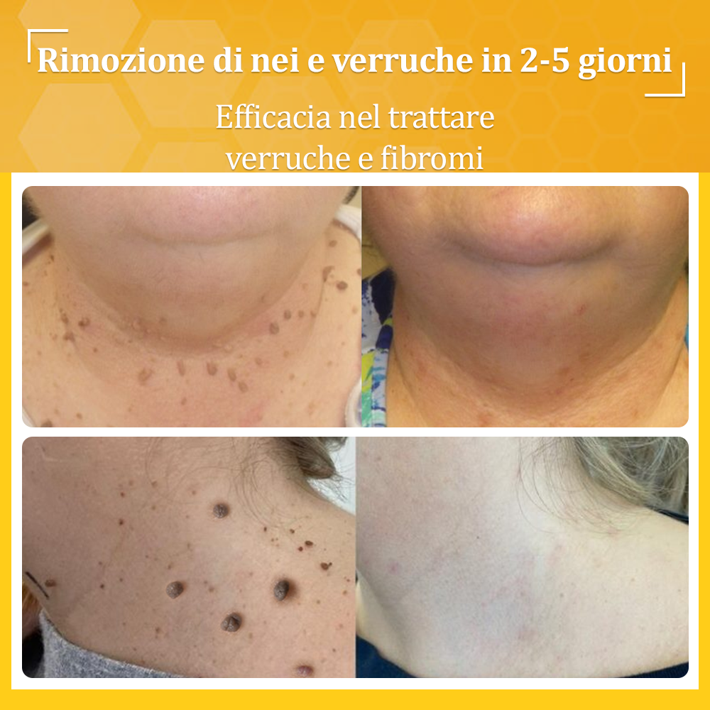 👨⚕️flysmus™ Cura Forte al veleno d'ape, Tratta verruche, escrescenze, infezioni e cicatrici, Leviga la pelle irregolare, Certificato dalla Società Italiana di Dermatologia (SIDeMaST) 🌟