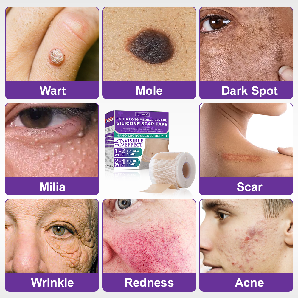 🏷️ Official Store: Flysmus® ReGen Hyaluronic Acid Nano-Heal Microneedle Tape - 💝Treatment of old and new scars, reduction of surgical scars, stretch marks, keloids, acne, burns, warts, dermatomes and varicose veins