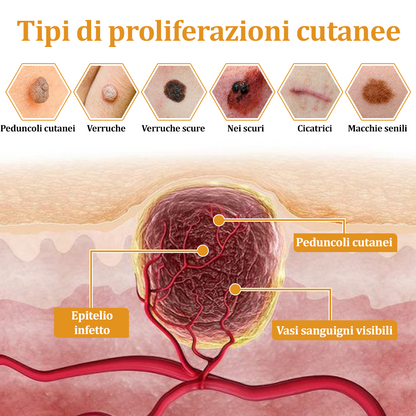 👨‍⚕️flysmus™ Cura Forte al veleno d'ape, Tratta verruche, escrescenze, infezioni e cicatrici, Leviga la pelle irregolare, Certificato dalla Società Italiana di Dermatologia (SIDeMaST) 🌟