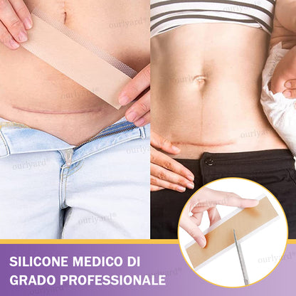 ✅ Negozio Ufficiale | Ourlyard® Nastro Riparatore a Microaghi con Acido Ialuronico🏥(Trattamento di cicatrici vecchie e nuove, riduzione di cicatrici chirurgiche, smagliature, cheloidi, acne, ustioni, verruche, dermatomi e vene varicose)