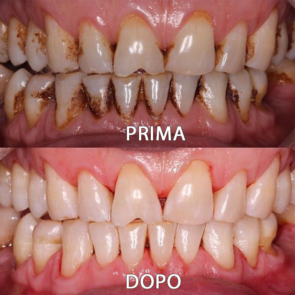 ✅👨🏻‍⚕️Negozio ufficiale | Ourlyard® Polvere minerale per la salute dei denti👨🏻‍⚕️Ottieni la certificazione Ottenuto la certificazione dell'Agenzia Italiana del Farmaco (AIFA)