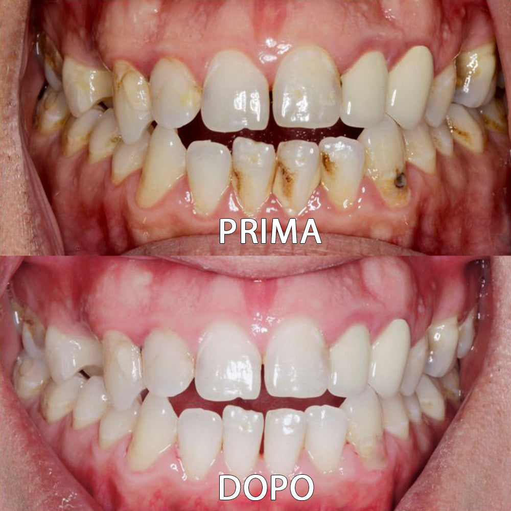 ✅👨🏻‍⚕️Negozio ufficiale | Ourlyard® Polvere minerale per la salute dei denti👨🏻‍⚕️Ottieni la certificazione Ottenuto la certificazione dell'Agenzia Italiana del Farmaco (AIFA)