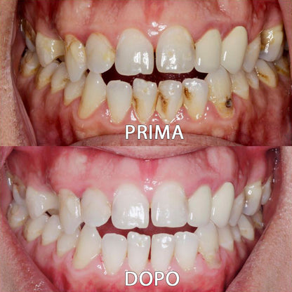 ✅👨🏻‍⚕️Negozio ufficiale | Ourlyard® Polvere minerale per la salute dei denti👨🏻‍⚕️Ottieni la certificazione Ottenuto la certificazione dell'Agenzia Italiana del Farmaco (AIFA)