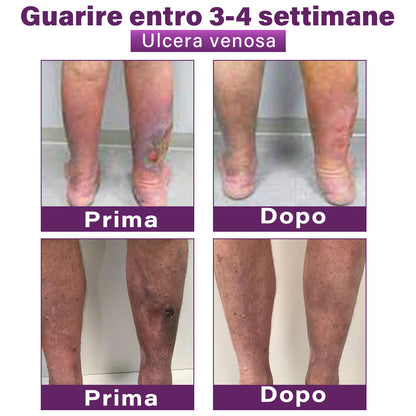 ✅ GFOUK® Cerotto Nano Varicose con Polidocanolo 👩🏼‍⚕️ Raccomandato dalla Società Italiana di Chirurgia Vascolare (Per Varici, Vene Varicose e Gonfiore alle Gambe)