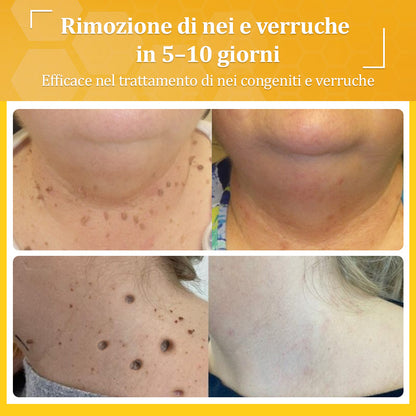 👨‍⚕️flysmus® Crema al Veleno d’Ape – Testata da dermatologi. Efficace contro verruche, noduli, lesioni, infezioni e cicatrici.