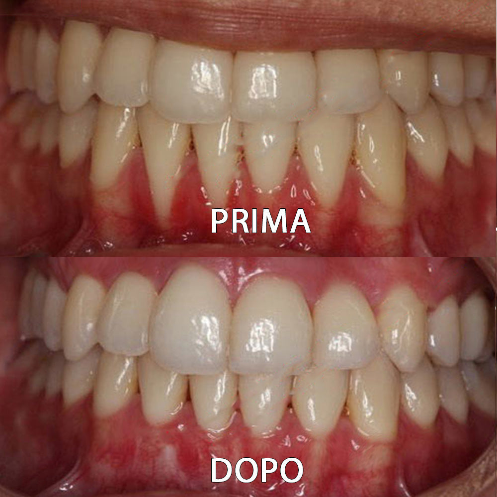 ✅👨🏻‍⚕️Negozio ufficiale | Ourlyard® Polvere minerale per la salute dei denti👨🏻‍⚕️Ottieni la certificazione Ottenuto la certificazione dell'Agenzia Italiana del Farmaco (AIFA)