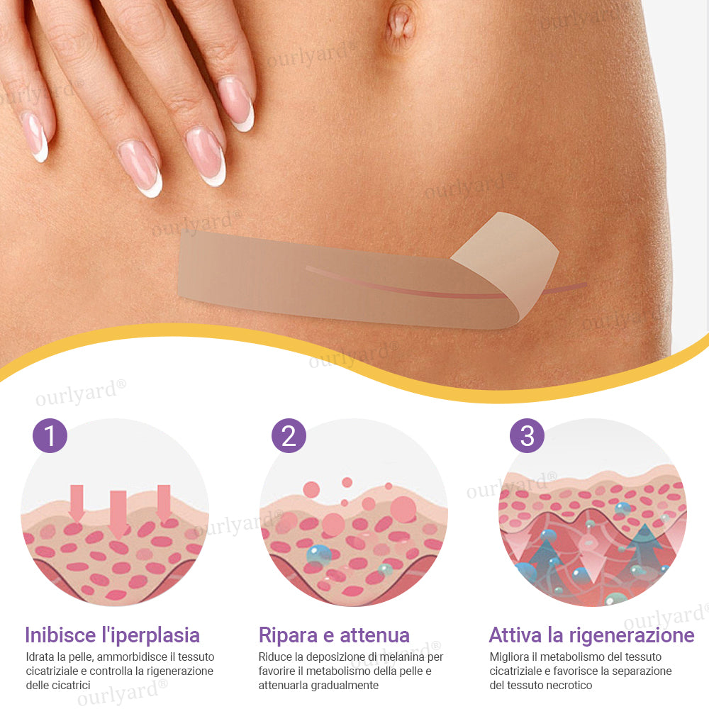 ✅ Negozio Ufficiale | Ourlyard® Nastro Riparatore a Microaghi con Acido Ialuronico🏥(Trattamento di cicatrici vecchie e nuove, riduzione di cicatrici chirurgiche, smagliature, cheloidi, acne, ustioni, verruche, dermatomi e vene varicose)